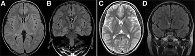 Molecular Diagnosis of Myoclonus Epilepsy Associated with Ragged-Red Fibers Syndrome in the Absence of Ragged Red Fibers